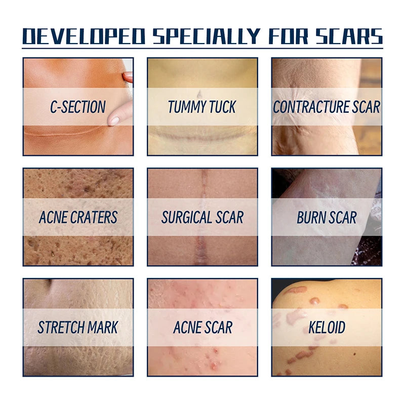 Herbal Scar Removal Cream Gel Repaire Pock Mark Burn Surgical Scar Cesarean Scar Stretch Mark Treatment Cream Smooth Skin Care
